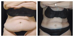 Coolsculpting Before And After Photos Marino 6