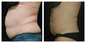Coolsculpting Before And After Photos Marino 7