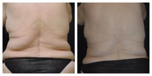 Coolsculpting Before And After Photos Marino 8