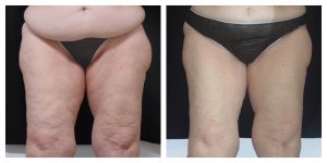 Coolsculpting Before And After Photos Marino 9