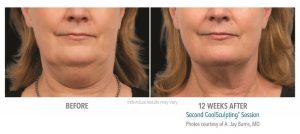 Coolsculpting Before And After