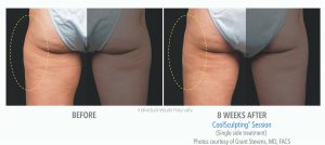 Coolsculpting Before And After Photos 2