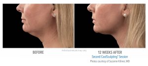 Coolsculpting Before And After