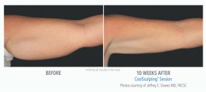 Coolsculpting Before And After