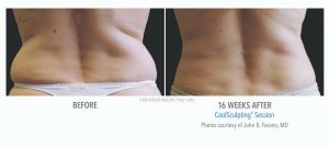 Coolsculpting Before And After Photos 3