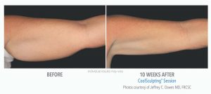 Coolsculpting Before And After Photos 4
