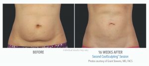 Coolsculpting Before And After