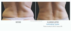 coolsculpting before and after