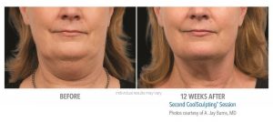 Coolsculpting Before And After Photos 5