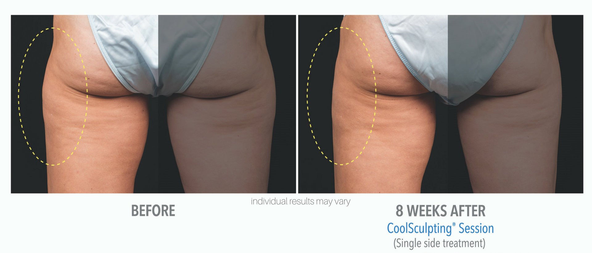 Cool Sculpting Before And After