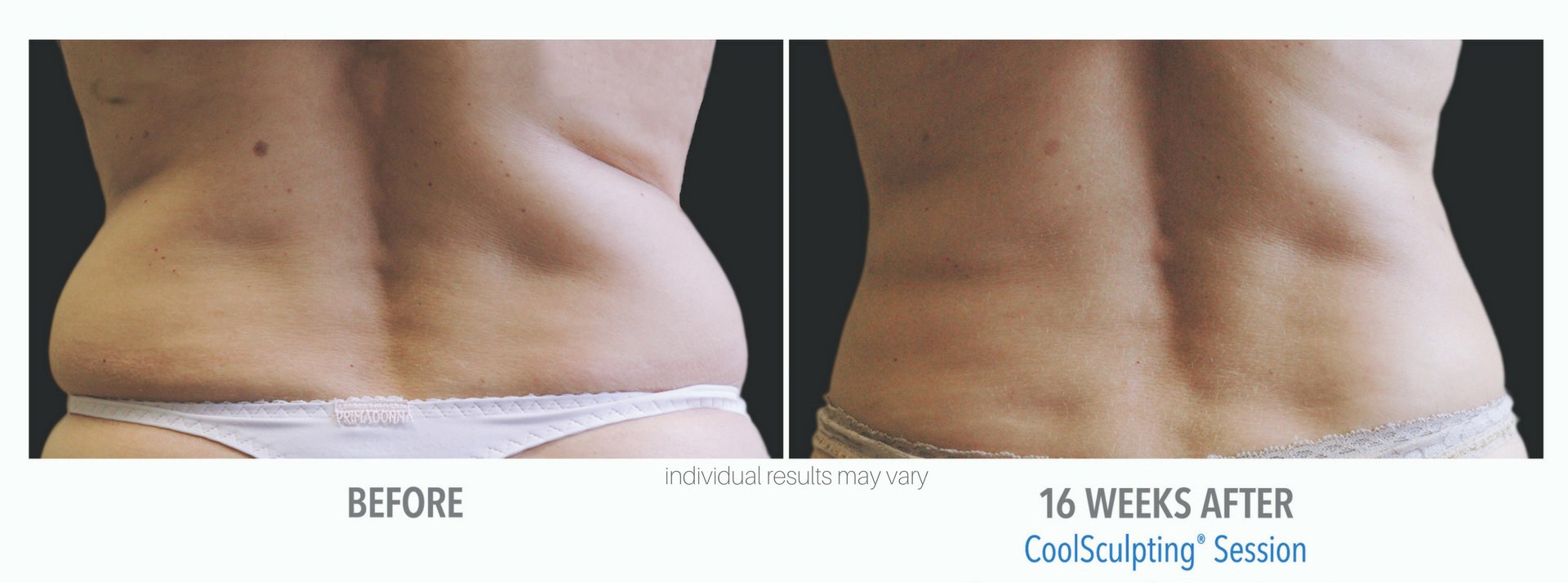 Coolsculpting Before And After