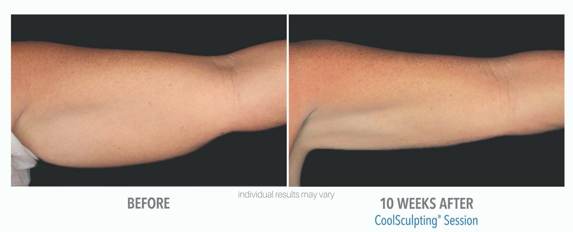 Coolsculpting Before And After