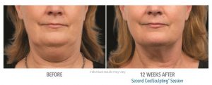Coolsculpting Before And After