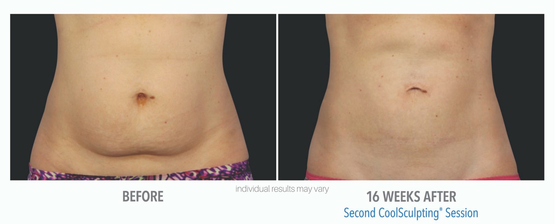 Cool Sculpting Before And After