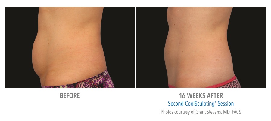 coolsculpting-before-and-after- coolsculpting-before-and-after-