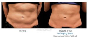Coolsculpting Before And After