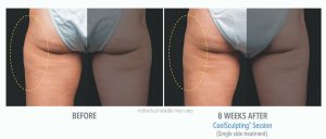 Coolsculpting Before And After Photos 2