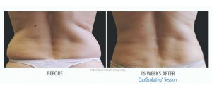 Coolsculpting Before And After Photos 3