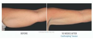 Coolsculpting Before And After Photos 4