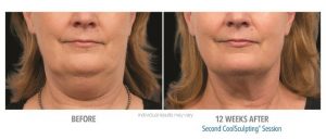 Coolsculpting Before And After Photos 5