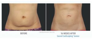 Coolsculpting Before And After 1