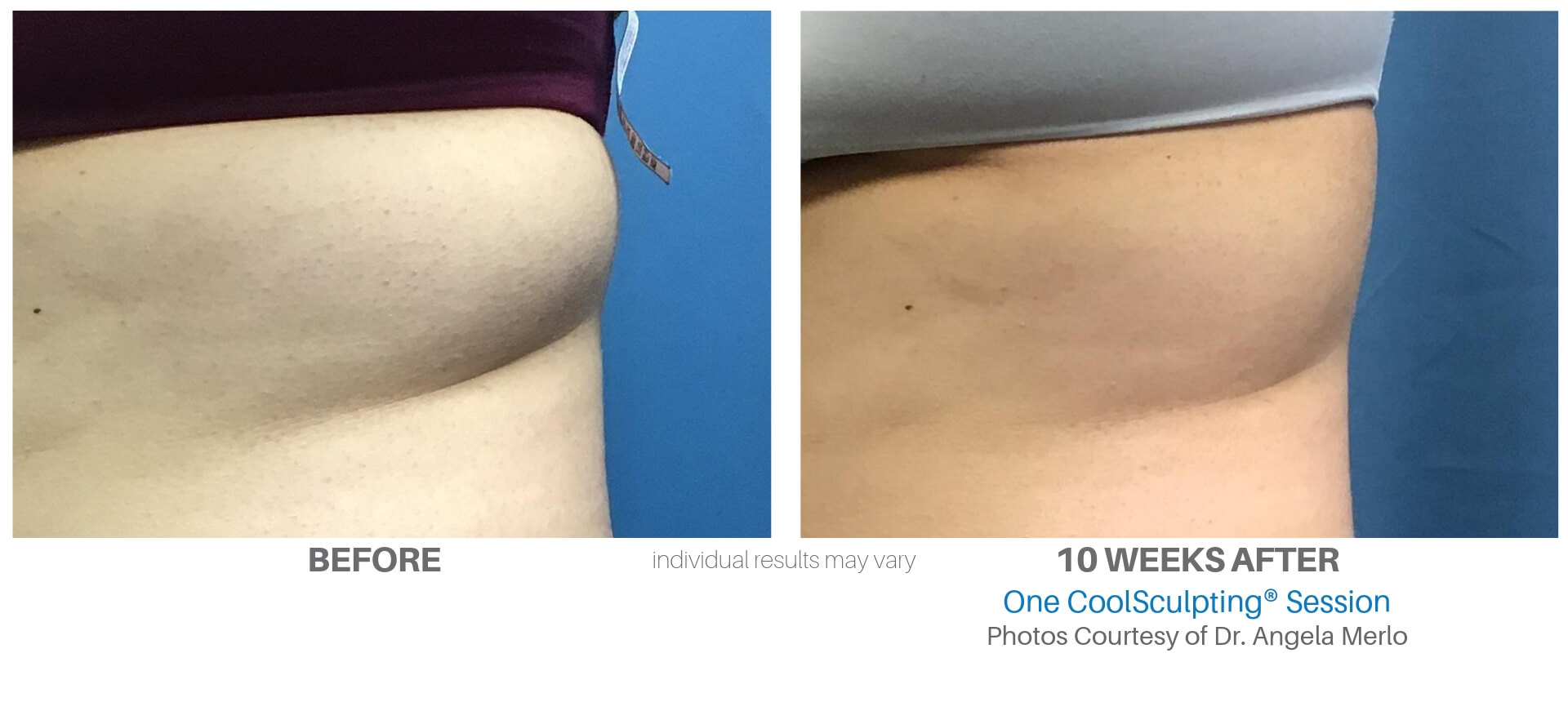 coolsculpting in Kansas City