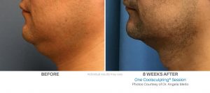 Coolsculpting Before And After