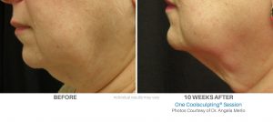 Coolsculpting Before And After