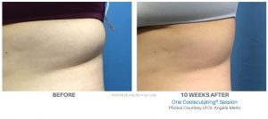 Coolsculpting Before And After