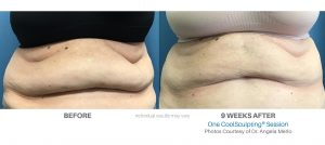 Coolsculpting Before And After