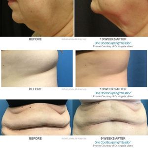 Coolsculpting Before And After Dr Merlo