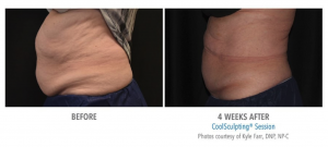 Before And After Coolsculpting