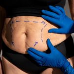 CoolSculpting Vs. Tummy Tuck: Key Differences