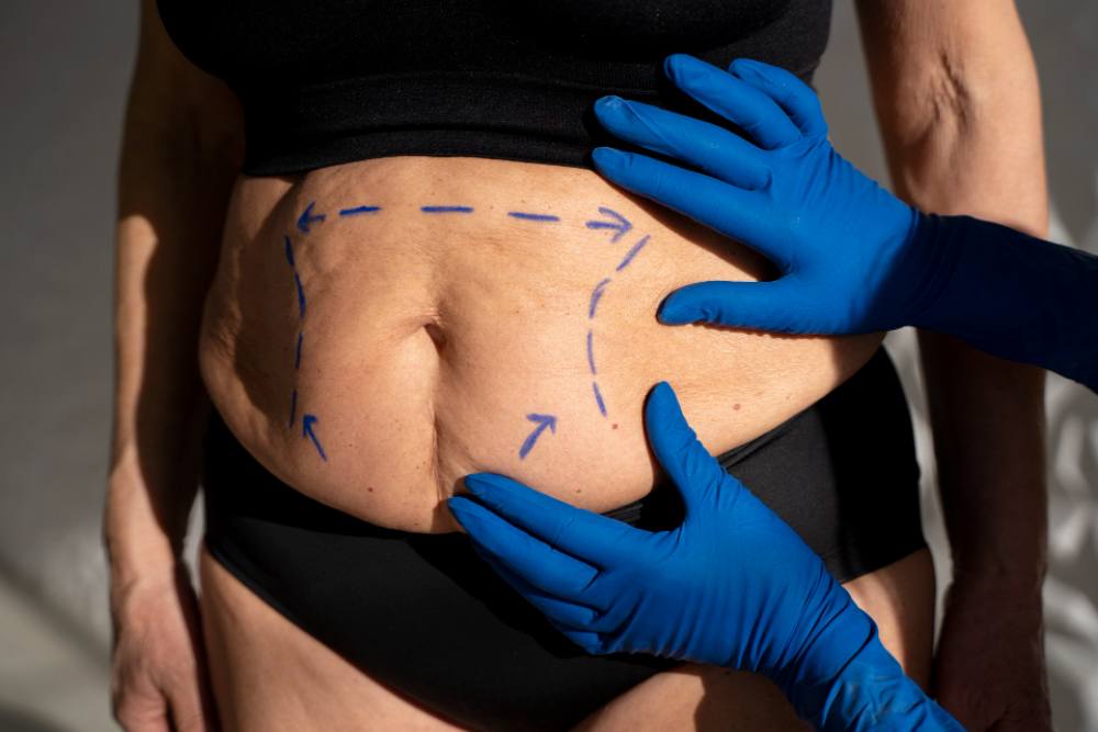 CoolSculpting Vs. Tummy Tuck: Key Differences