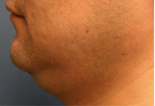 Before body contouring — chin