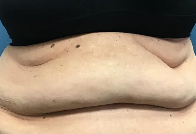 Before body contouring — abdomen