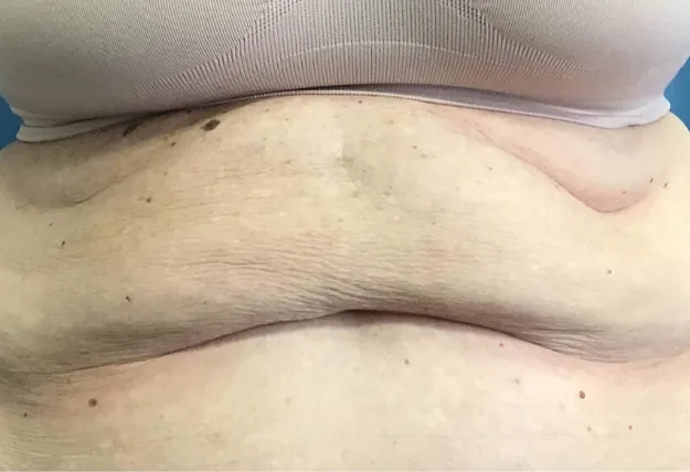 After CoolSculpting — abdomen