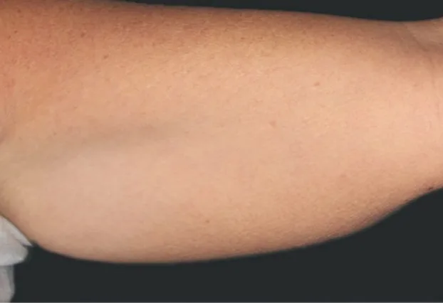 Before CoolSculpting — arm
