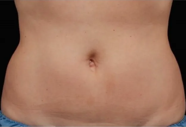After CoolSculpting — flanks
