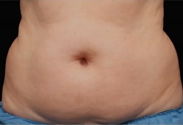 Before CoolSculpting — flanks