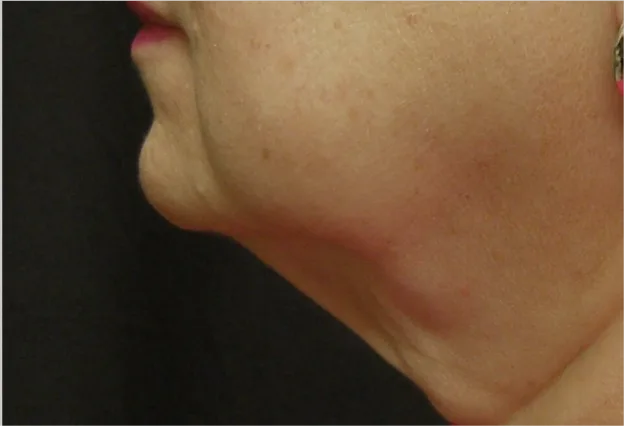 After CoolSculpting — chin profile